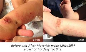 Oxygen Bathing, Micro-bubbles Relieve   Toddler's Crippling Skin Condition