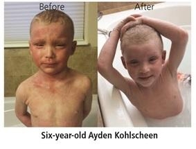 MicroSilk Bathing Technology Relieves Child's Severe Eczema Through Tiny Bubbles and Oxygen