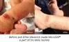 Oxygen Bathing, Micro-bubbles Relieve   Toddler's Crippling Skin Condition