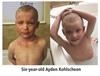 MicroSilk Bathing Technology Relieves Child's Severe Eczema Through Tiny Bubbles and Oxygen